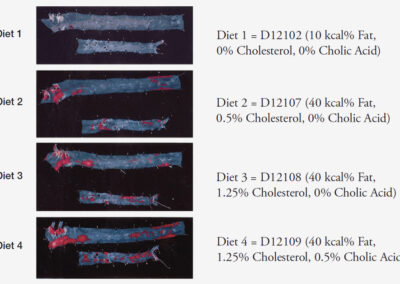 Atherosclerosis